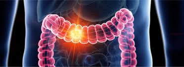 Why are more under-50s getting colorectal cancer? – Report