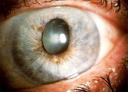 glaucoma