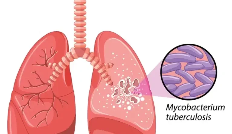 FCT records 16,000 TB cases as treatment success hits 94%