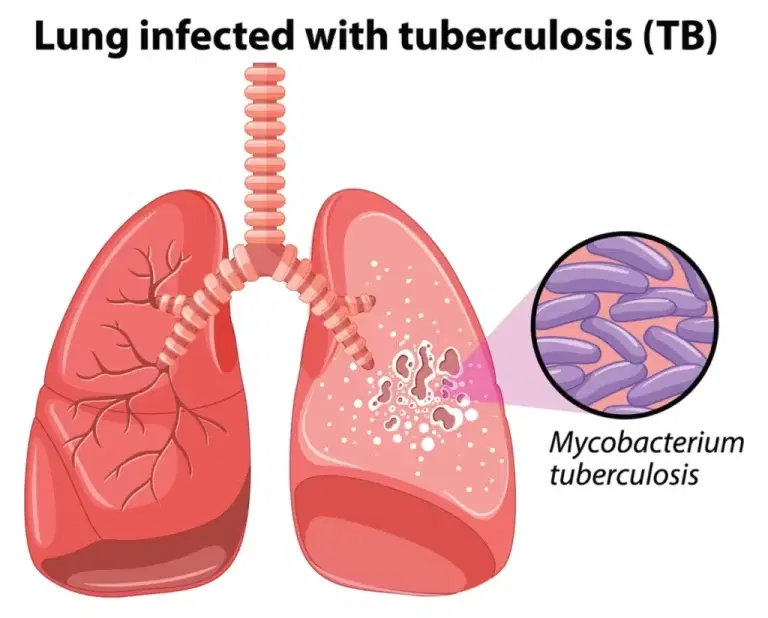 FCT records 16,000 TB cases as treatment success hits 94%