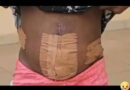 Nigerian teen trafficked to Ivory Coast for prostitution loses womb