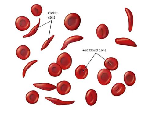 Ignorance, misinformation fuel rising sickle cell cases in Nigeria