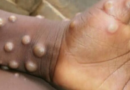 mpox