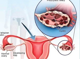 Ovary Syndrom: No one wants to marry a ‘diseased’ woman!