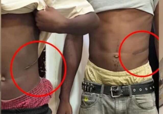 N1.5m for kidney: Lawyer alleges illegal organ harvest in Abuja