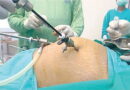 Beyond Surgery: Can nutrition and lifestyle help prevent uterine fibroids?