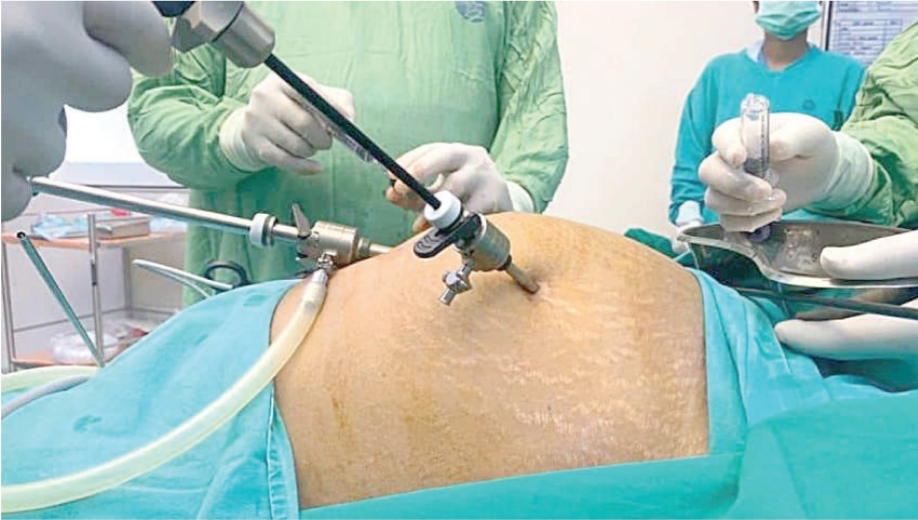 Beyond Surgery: Can nutrition and lifestyle help prevent uterine fibroids?