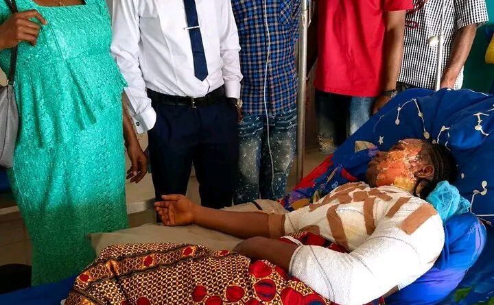 Hot water attack: University student hospitalised with severe burns in Benue