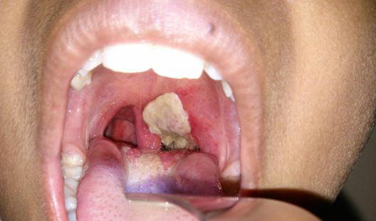 Zero-dose children contributing to Kano’s diphtheria burden – KNCDC