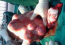 100 women undergo OBLBF free surgery to remove uterine fibroid